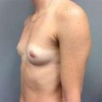 Breast Augmentation Before & After Patient #778