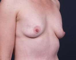 Breast Augmentation Before & After Patient #785