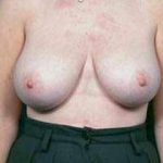 Breast Mastopexy Before & After Patient #148