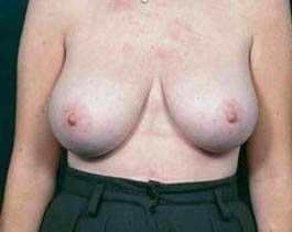 Breast Mastopexy Before & After Patient #148