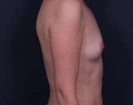 Breast Augmentation Before & After Patient #853