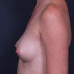 Breast Augmentation Before & After Patient #861