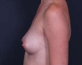 Breast Augmentation Before & After Patient #861
