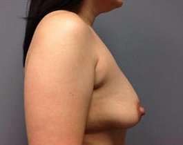Breast Augmentation Before & After Patient #871