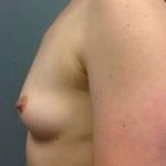 Breast Augmentation Before & After Patient #878