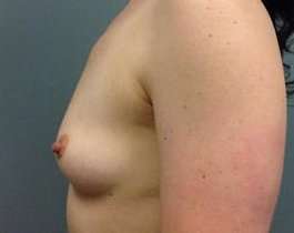 Breast Augmentation Before & After Patient #878