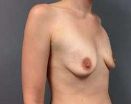Breast Augmentation Before & After Patient #899