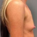 Breast Augmentation Before & After Patient #904