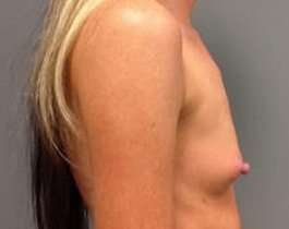 Breast Augmentation Before & After Patient #904