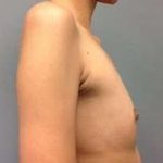 Breast Augmentation Before & After Patient #918