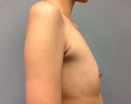Breast Augmentation Before & After Patient #918