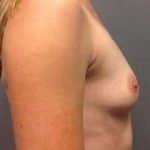 Breast Augmentation Before & After Patient #925