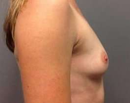 Breast Augmentation Before & After Patient #925