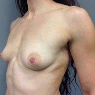 Breast Augmentation Before & After Patient #932