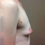 Breast Augmentation Before & After Patient #952