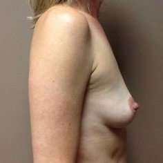 Breast Augmentation Before & After Patient #966