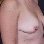 Breast Mastopexy Before & After Patient #162