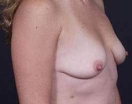 Breast Mastopexy Before & After Patient #162