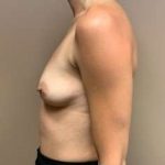 Breast Augmentation Before & After Patient #998