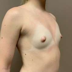 Breast Augmentation Before & After Patient #1015