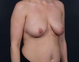 Breast Mastopexy Before & After Patient #169
