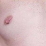 Breast Miscellaneous Before & After Patient #75