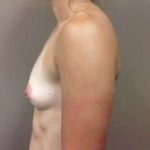Breast Augmentation Before & After Patient #1046