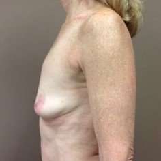 Breast Augmentation Before & After Patient #1058