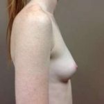 Breast Augmentation Before & After Patient #1070