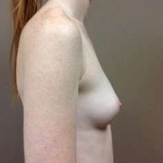 Breast Augmentation Before & After Patient #1070