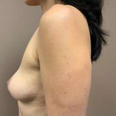 Breast Augmentation Before & After Patient #1082