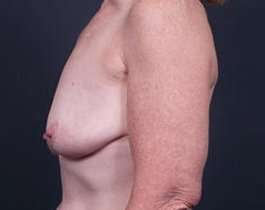 Breast Mastopexy Before & After Patient #183