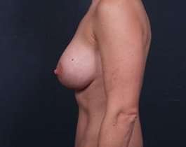 Breast Mastopexy Before & After Patient #190
