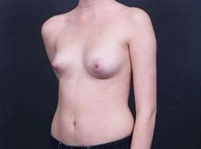 Breast Asymmetry Before & After Patient #1215