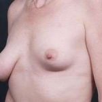 Breast Asymmetry Before & After Patient #1220