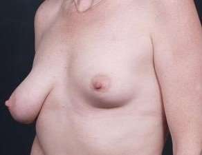 Breast Asymmetry Before & After Patient #1220