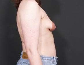 Breast Asymmetry Before & After Patient #1225