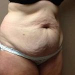 Tummy Tuck Before & After Patient #1233