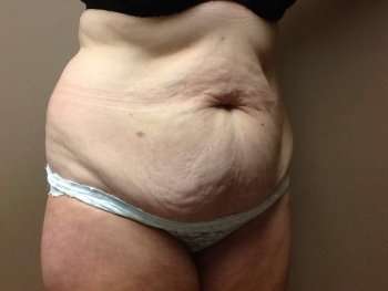 Tummy Tuck Before & After Patient #1233