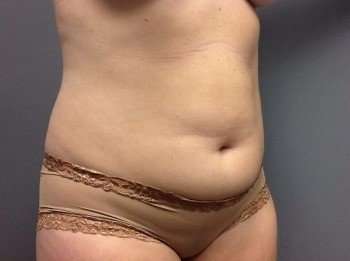 Tummy Tuck Before & After Patient #1238