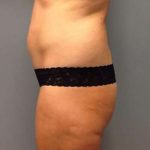 Tummy Tuck Before & After Patient #1243