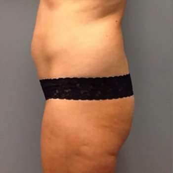 Tummy Tuck Before & After Patient #1243