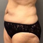 Tummy Tuck Before & After Patient #1251
