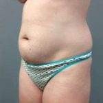 Tummy Tuck Before & After Patient #1256