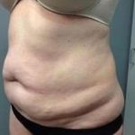 Tummy Tuck Before & After Patient #1263