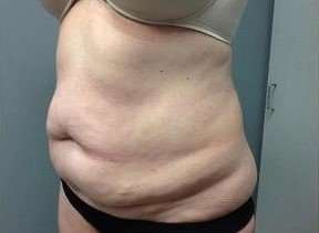 Tummy Tuck Before & After Patient #1263
