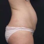 Tummy Tuck Before & After Patient #1270