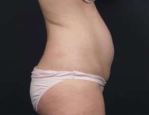 Tummy Tuck Before & After Patient #1270