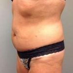 Tummy Tuck Before & After Patient #1277