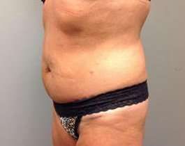 Tummy Tuck Before & After Patient #1277